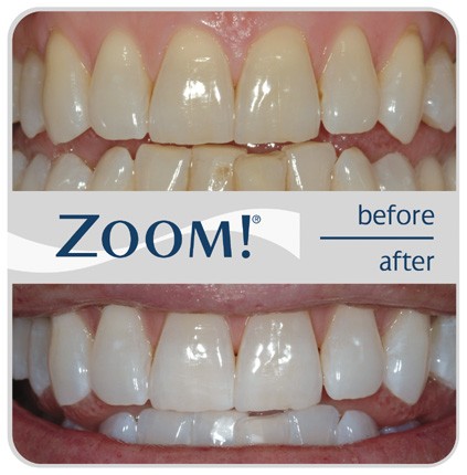 Antioch CA Zoom Whitening